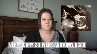 OUR BABY HAS A 2 VESSEL UMBILICAL CORD | PREGNANCY COMPLICATIONS | 20 WEEK PREGNANCY UPDATE