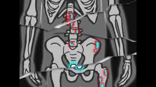 NEJM: Radium-223 in cancerul de prostată metastatic