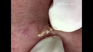 Acne clear -  Blackhead removal -  Beauty care video #32