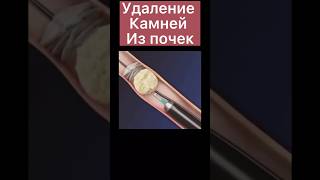 УДАЛЕНИЕ КАМНЕЙ ИЗ ПОЧКИ С ПОМОЩЬЮ УЛЬТРАЗВУК🧑‍⚕️ а у вас были комни в почках😳? #медицина #хирург