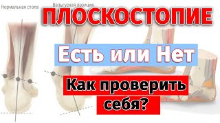 Плоскостопие. Как проверить себя и близких, есть или нет?