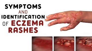 Symptoms and identification of  different types of Eczema rashes