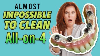 Why All-on-4 Teeth Are Impossible to Keep Clean!