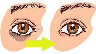 Learn The Best Natural Treatments To Remove Dark Circles and Bags Under The Eyes