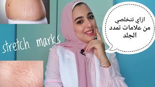 أفضل الطرق الطبية لعلاج ال stretch marks او علامات تمدد الجلد