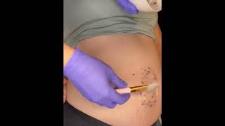 Belly Facial - Pregnancy Safe Facial - Ashley Aesthetics #shorts