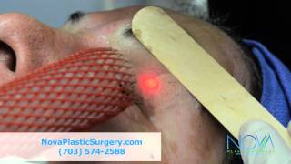 Facial Laser Procedure at NOVA Plastic Surgery in Virginia