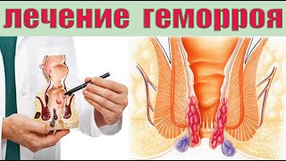 Как правильно использовать мази и свечи при геморрое