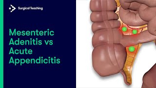 Mesenteric Adenitis vs Appendicitis | How to tell the difference?