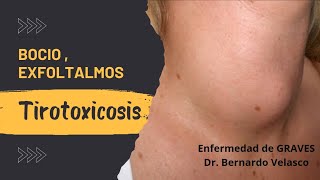 ABULTAMIENTO EN CUELLO, TAQUICARDIA, NERVIOSISMO: Tirotoxicosis Enfermedad de GRAVES Ojos saltones