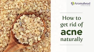 How to Get Rid of Acne Naturally with Essential Oils