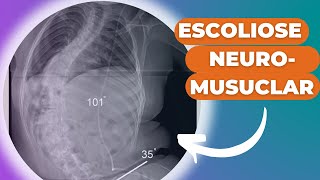 Escoliose Neuromuscular de forma facil de entender