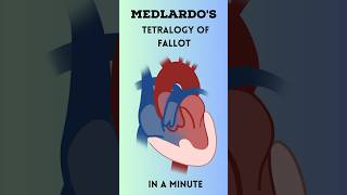 Tetralogy of Fallot in a Minute! 🩺 #Medicine #MedicalStudent #Doctor #Nurse #MedSchool #MedStudent