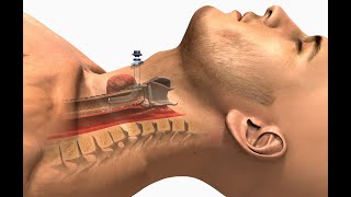 tracheostomy @selflessmedicose @CompleteAnatomyElsevier