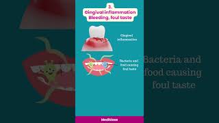 Sequel of Food impaction #gumdisease #periodontaldisease #caries