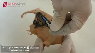 'EZgoma®' GUIDED technology for Zygomatic and Pterygoid implantation