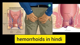 Hemorrhoids in hindi | hemorrhoids types , causes , symptoms |