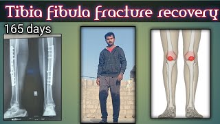 165 days Tibia fibula fracture recovery,and skin grafting in hindi ,urdu