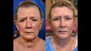 Sandra Patient Testimonial  - 2 Weeks Post Face and Neck Lift