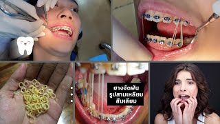 วิธีเกี่ยวยางดึงฟันเป็นรูปสามเหลี่ยมและสี่เหลี่ยม (Triangle & Box elastics)