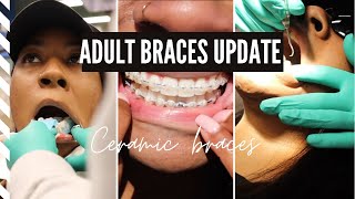 ADULT BRACES VLOG | Come with me to get my braces changed | ceramic braces routine