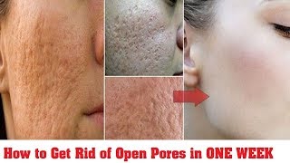 How to Treat Open Pores - Effective Home Remedies To Treat Open Pores