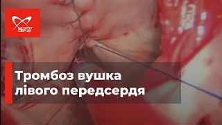 Тромбоз вушка лівого передсердя 🔷 Інститут серця