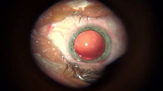 POBH Posterior capsulorhexis