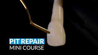 Composite Veneer Pit Repair with Dr. Dennis Hartelieb