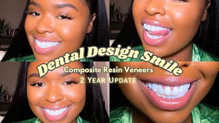 Dental Design Smile Miami Composite Veneers | ALL YOU NEED TO KNOW | Two Year Update!