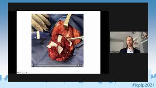 ICPLP2021 - A.Prof. Shores & A. Prof. Tuffaha: Contemporary Surgical Approaches for Neuroma ...