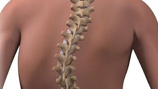 #scoliosis -spine surgeryस्कोलियोसिस सर्जरी से मुड़ी हुई &रीढ़ की हड्डी को किया सीधा