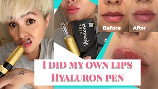 HYALURON PEN, I DID MY OWN LIPS, WOW!! Tutorial and Result