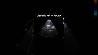 Diastolic MR in AV block - APLAX