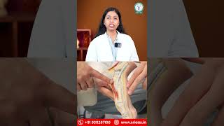 What is Foot Ulcer | Management and Prevention | SRIAAS #sriaas #shorts #ulcer