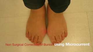 Non surgical correction of bunion 2014