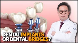 How to choose from Dental Implants & Dental Bridges? - Everything you need to know about Implants