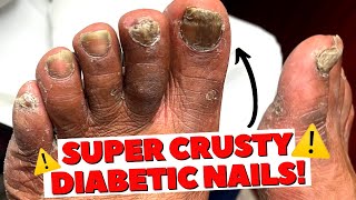 NAIL CUTTING AND CALLUS REMOVAL ON DIABETIC PATIENT! | Diabetic Foot Care | Dr Kim