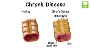 Crohn's Disease - Natural Home Remedies