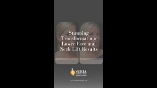 Stunning Transformation: Lower Face and Neck Lift Results