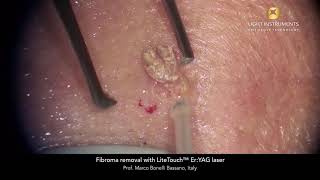 Fibroma removal II with LiteTouch™ Er:YAG laser