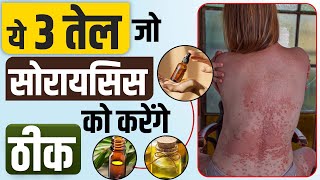 3 तेल जो Psoriasis को दूर करे | Best Oil For Psoriasis In India | Which Oil Apply In Psoriasis