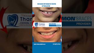 Why DAMON™SMILE BRACES is Best? Regular  Metal Braces versus Damon Braces