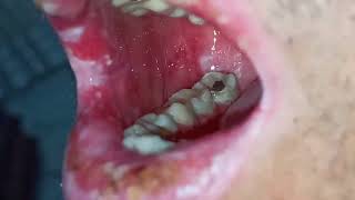 Oral lichen planus