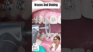 Disking between teeth during Braces