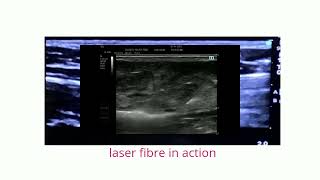 3 D ultrasound  and EVLA at Capital Vein Links Clinic 780 454 0351