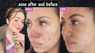 Sun Block For oily Skin | Best Sunscreen For Sensitive Acne Prone Skin | sunblock Review