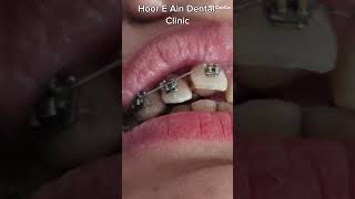 braces treatment changes your smile #music #love #instrumental #dentist #dentalesthetics #smile