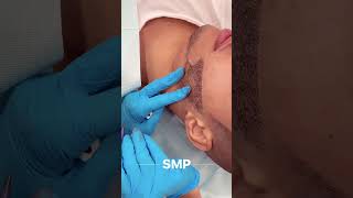 Transform Your Beard with Scalp Micropigmentation (SMP) | Dubai’s Top Beard Enhancement Treatment