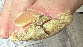 Trimming Extremely THICK And Cracked Callus!